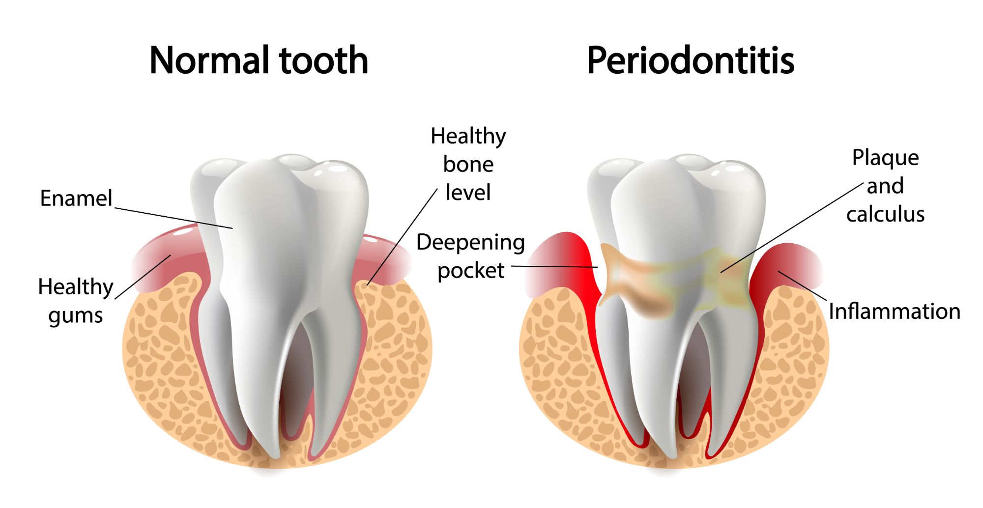 Image of normal vs periodontitis teeth