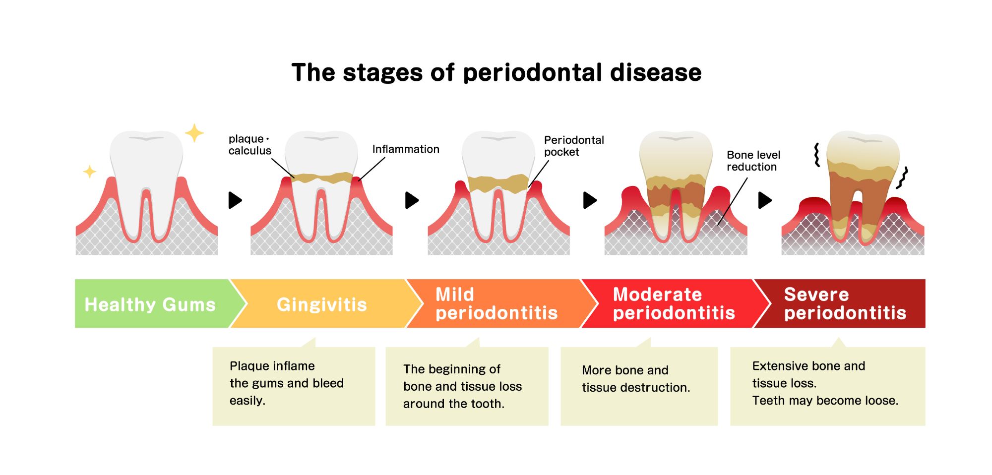The stages of periodontal disease