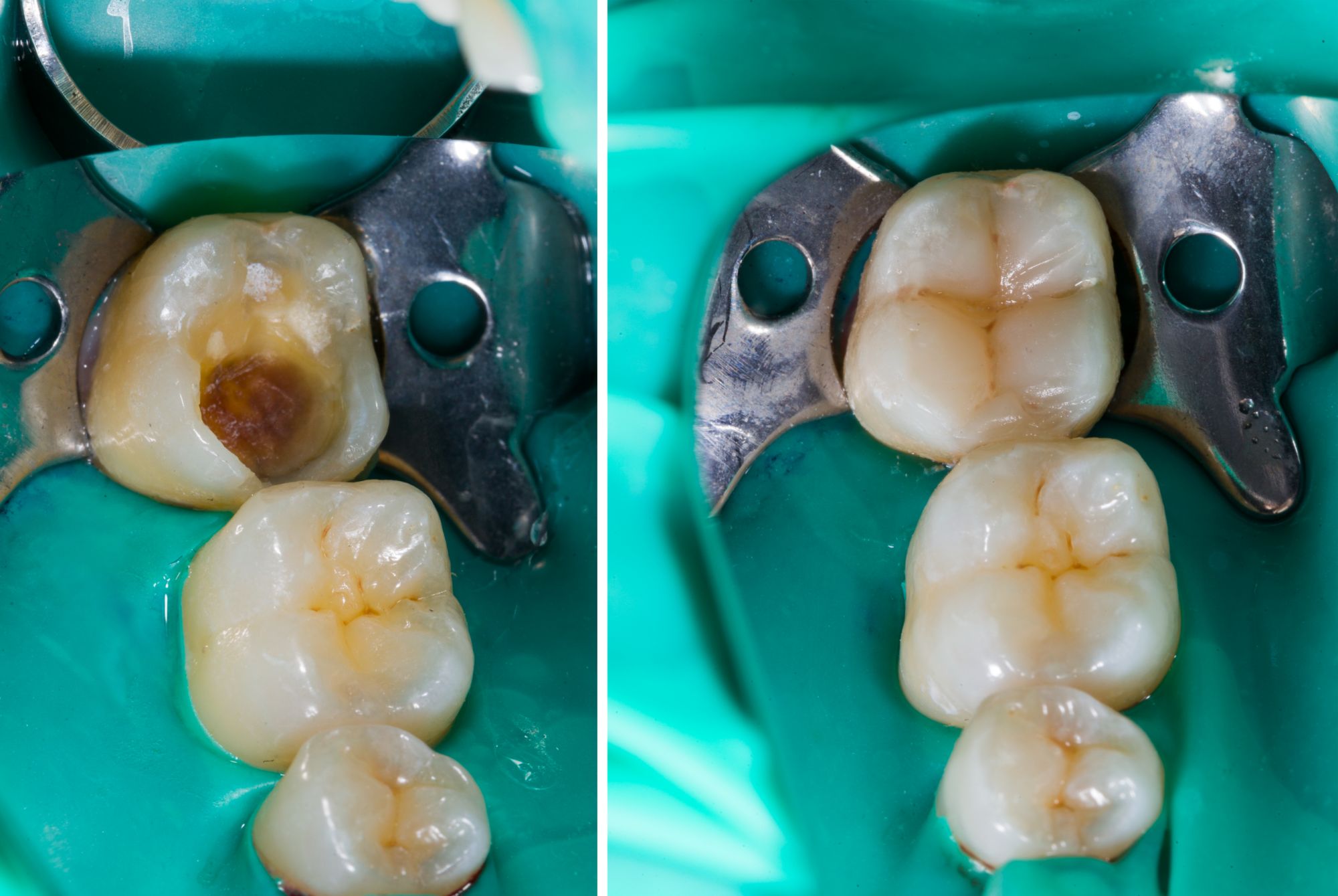 Image of dental work in progress