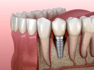 Image of Dental Implant