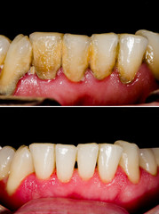 Image showing before and after plaque removal