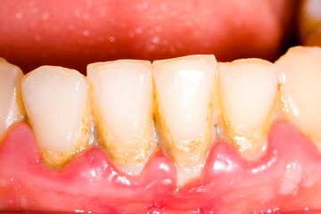 Image showing Periodontitis