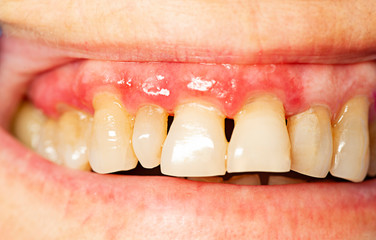 Image showing periodontitis